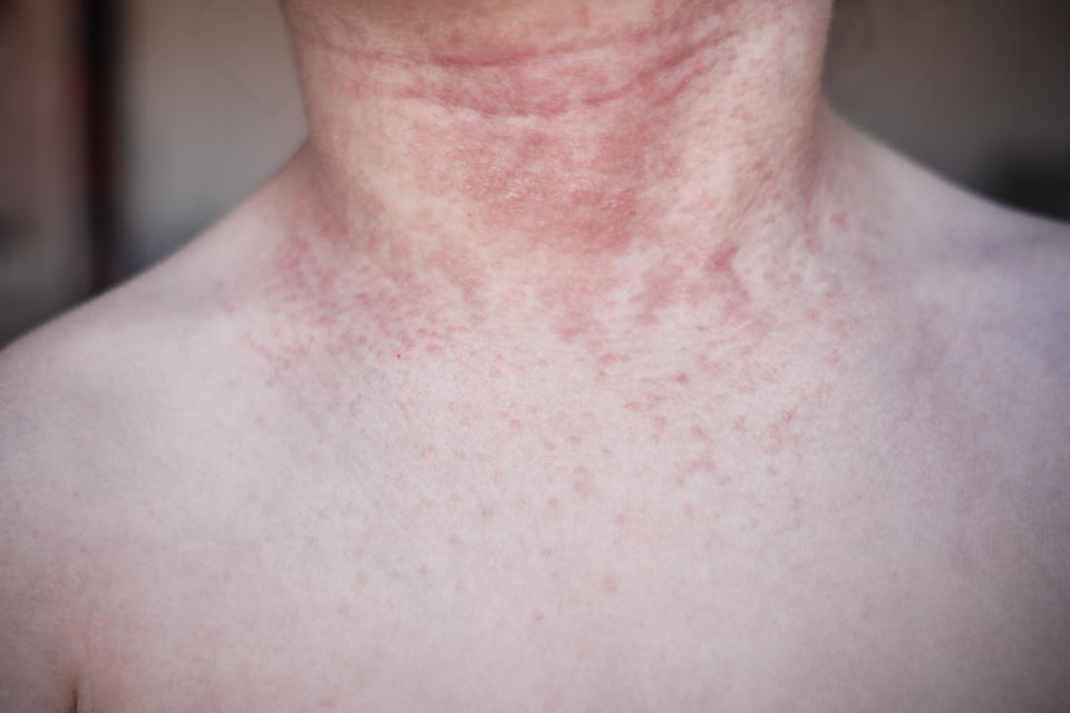 Close-up of a person's neck with a visible red rash, potentially an internet-found unusual medical condition