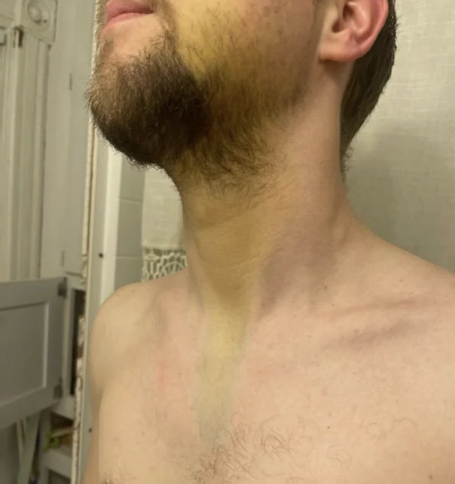 A shirtless person with noticeable bruising and yellow discoloration on the neck and upper chest. Face is partially visible