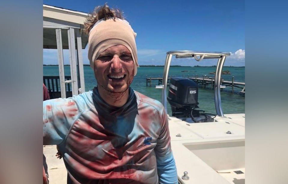 Will Krause, from Florida, US, left blood-stained but alive after a shark appeared and bit his head in waters off the Bahamas. Source: Will Krause / YouTube