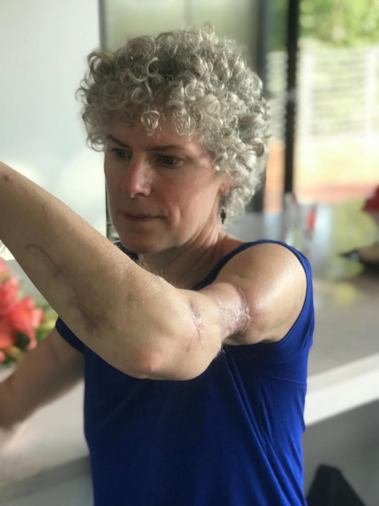Dominique Alain lost her triceps in a 2019 dog attack. A Quebec Superior Court judge ordered the town and dog owner Alan Barnes to pay her nearly $460,000.   (Denis Gervais/Radio-Canada - image credit)