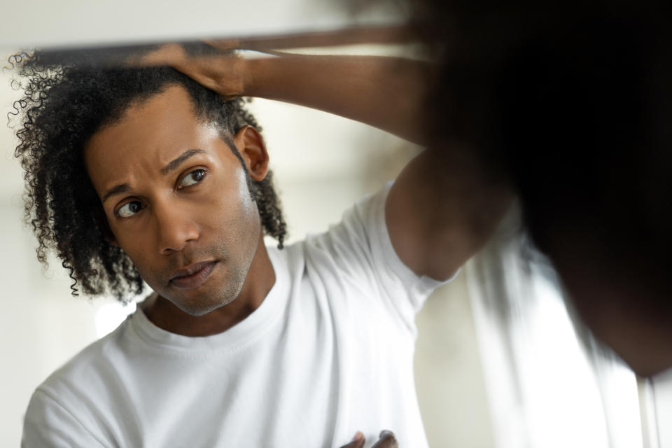Man worried for alopecia checking hair for loss. (Getty Images)