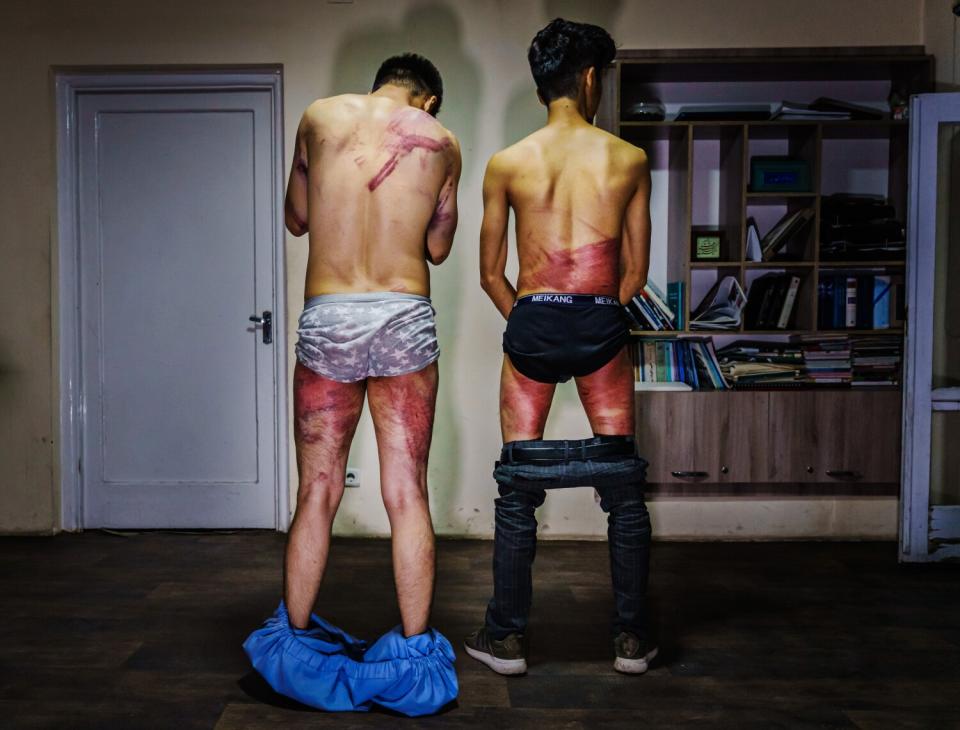 Two men show their back and leg wounds after Taliban fighters tortured and beat them