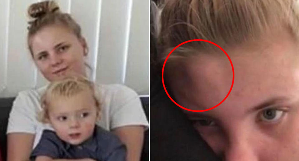 Pictured left is Jorgia Robson, 20, with her son Hunter, 2, and a large 'pimple', right, on her head.