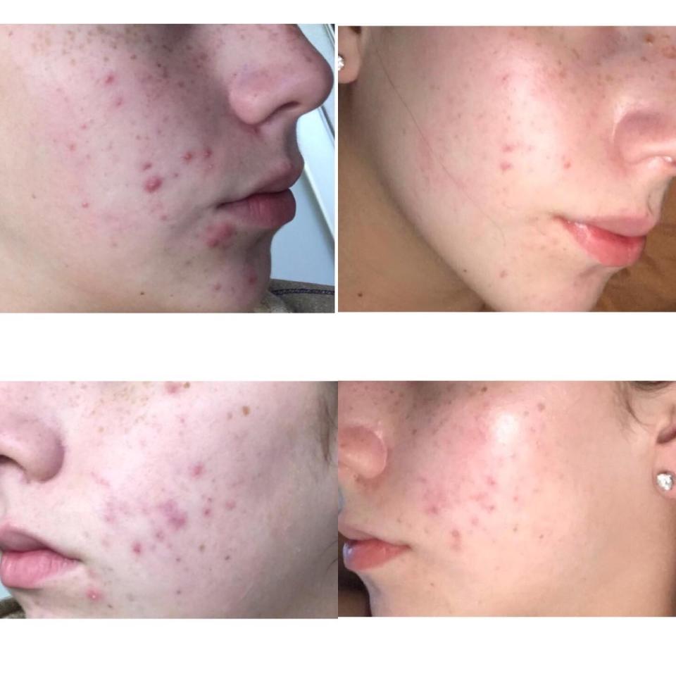 Both cheeks of a reviewer before and after using the mask, with very reduced acne after