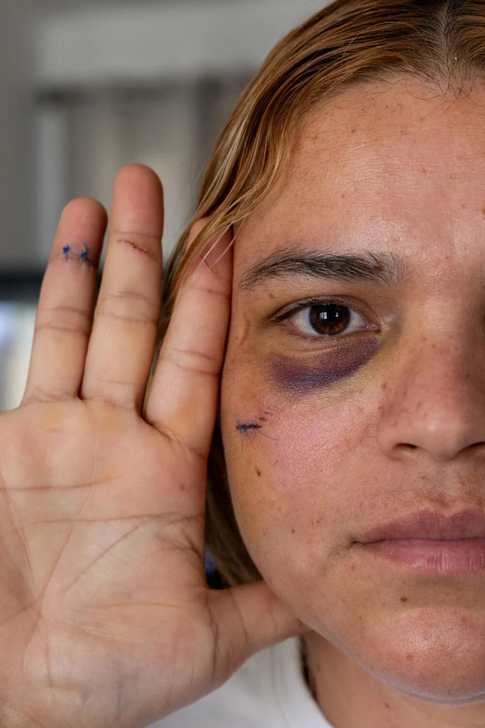 Karina Cerón muestra sus puntos y hematomas en su casa el viernes 6 de septiembre de 2024.