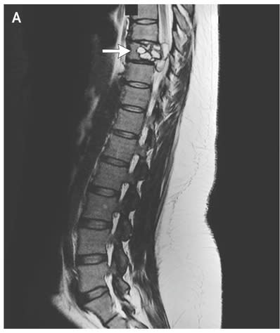 An MRI scan revealed live tape worm larvae near the woman’s vertebrae. Source: The New England Journal of Medicine