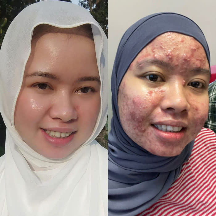 Bella suffered from extreme acne breakouts