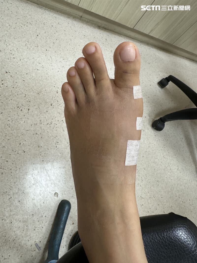 手術後交疊的兩根腳趾回到正常狀態，小模也結束「掰咖」人生。（圖／亞大醫院）