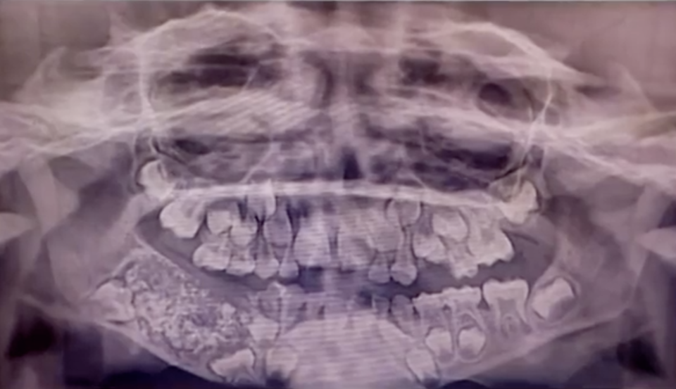 An x-ray of the boy's teeth before the operation. Source: Reuters