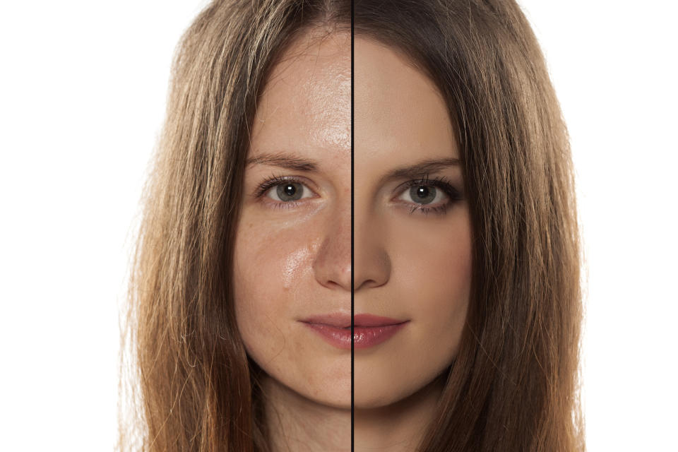 Oily-Skin-Before-After-Stock-Photo