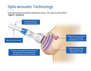 OA/US technology combines laser optics and grayscale ultrasound to provide fused functional and anatomical breast imaging. The opto-acoustic images provide a unique blood map in and around breast masses, while the ultrasound provides a traditional anatomical image.