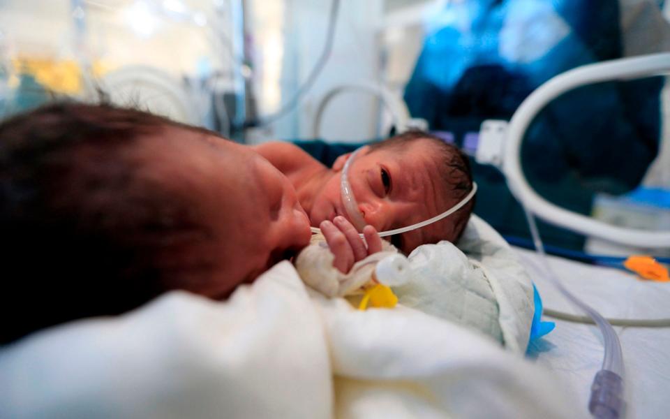Newborn conjoined twins lie in an incubator at the child intensive care unit of al-Sabeen hospital in Yemen's capital Sanaa - MOHAMMED HUWAIS /AFP