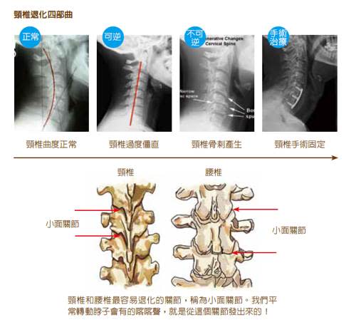 頸部變形,低頭族