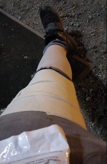 Jordan Greco shared this photo of his injured left leg after getting "clipped" by a bull that jumped over a fence at the Redding Rodeo on Friday night, May 20, 2022.