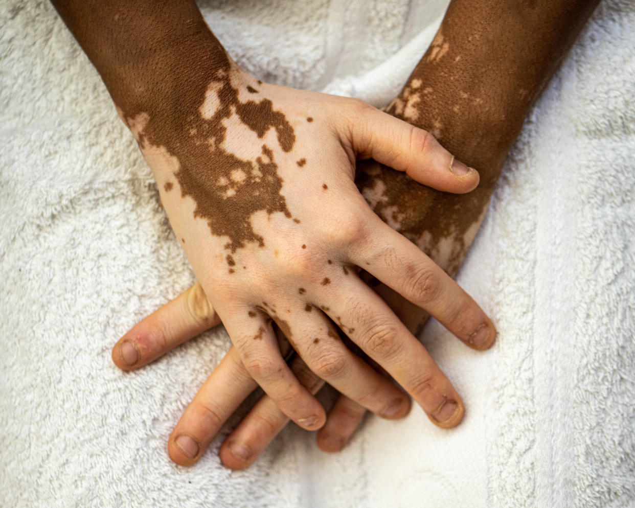 Les Français atteints de vitiligo ont désormais accès à un traitement remboursé