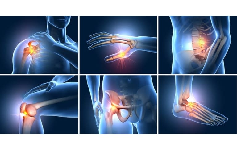 La imagen muestra las principales articulaciones del cuerpo que suelen verse afectadas por la artrosis