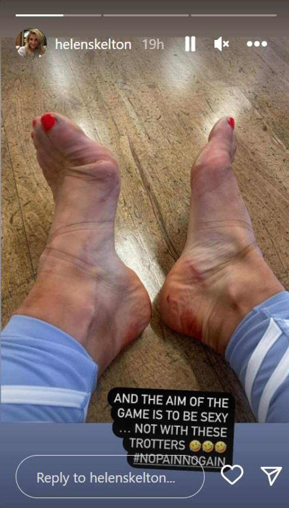 The Countryfile presenter’s feet took a battering during training for the BBC dance competition (Helen Skelton/Instagram)