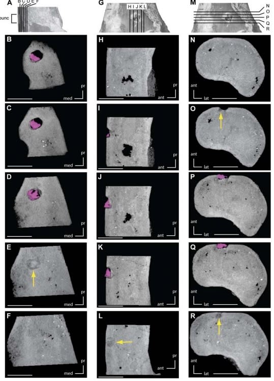 CT scans show puncture marks and embedded croc teeth in a juvenile dinosaur bone.