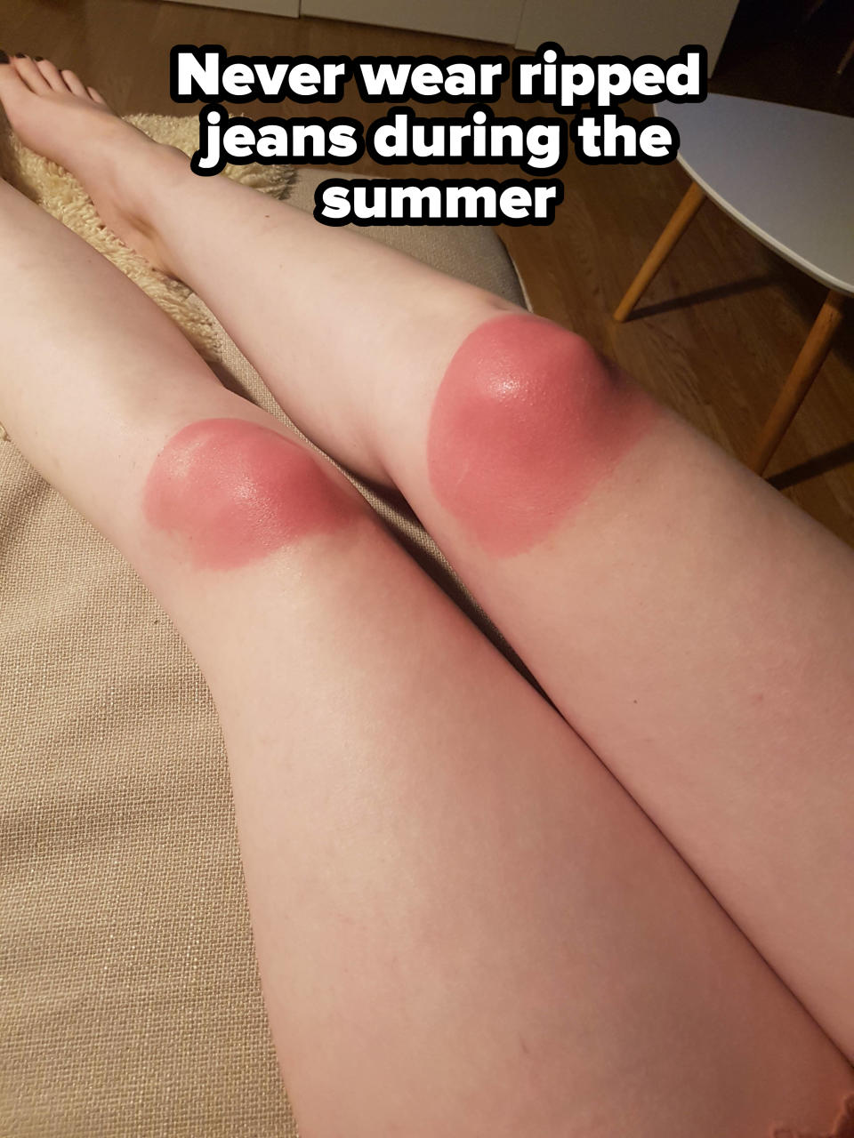 A person with sunburn on their knees