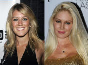 Heidi Montag era una chica linda, un rostro fresco y juvenil. Su problema: se quiso parecer más a una muñeca Barbie. Actualmente su nariz y labios lucen cero naturales. Esperemos que Heidi no quiera seguir por ese camino.