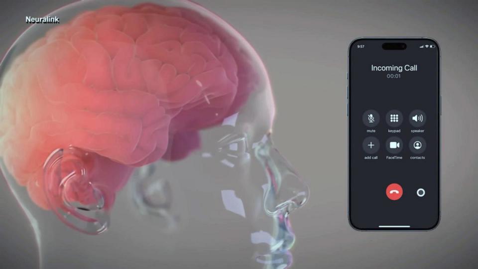 PHOTO:  Neuralink says its devices can help people with debilitating conditions control external devices. (Neuralink)