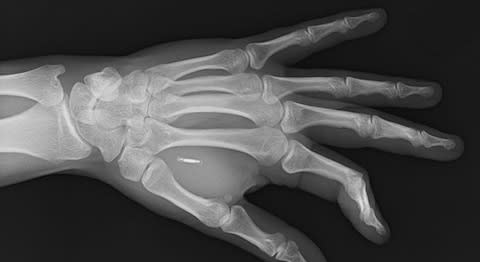 An X-ray showing the microchip inserted into Mr Northam's hand  - Credit: Solent