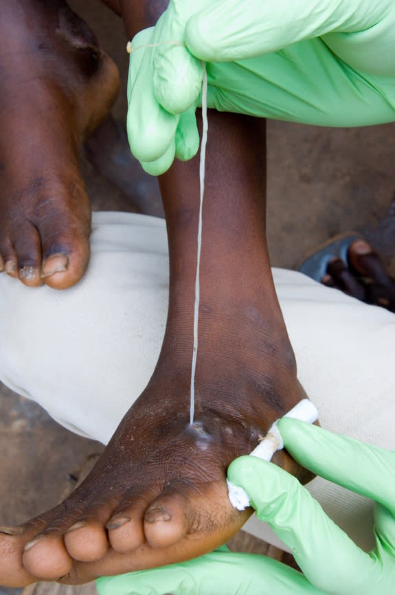 A health care worker wraps an emerging Guinea worm around a moist bandage to prevent it from breaking.