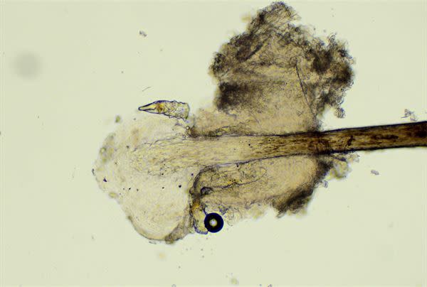 顯微鏡下的皮脂蠕形蟎蟲。（圖片／亞大醫院提供）