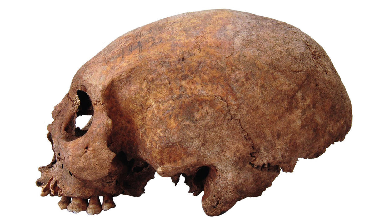  Artificially elongated skull of a woman buried in the 11th century on the Baltic island of Gotland. 