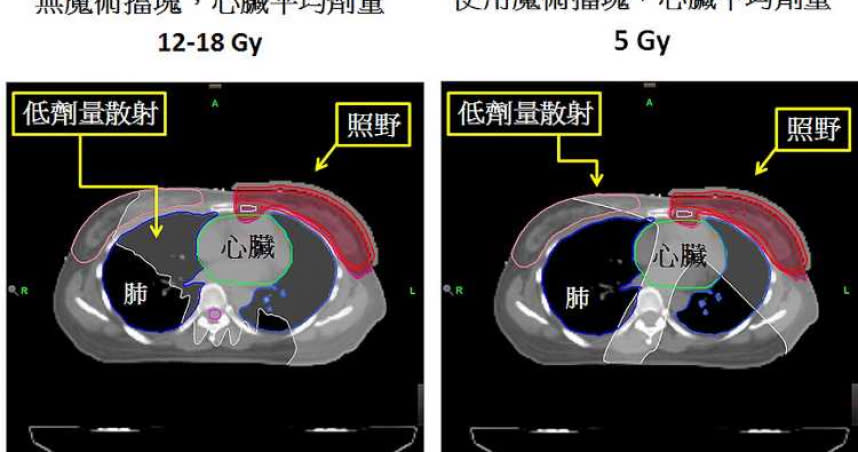 接受「智慧擋塊」技術的乳癌病人，會使原來平均需接受12-18 Gy輻射劑量左右的心臟，大幅降低到5 Gy左右，約可降低60%~70%日後可能產生的心臟疾病風險。（圖／亞東醫院提供）