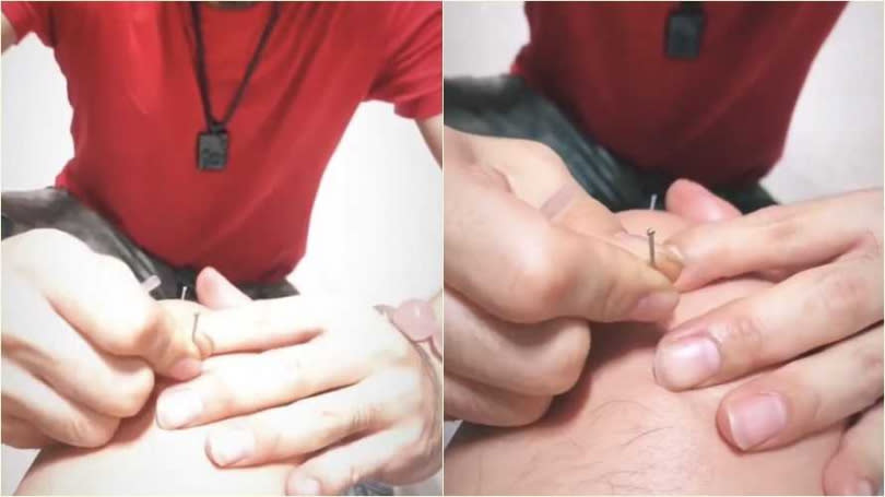 林書豪曾在IG限時動態放上被羅姓按摩師針灸的影片。（圖／翻攝自林書豪IG）