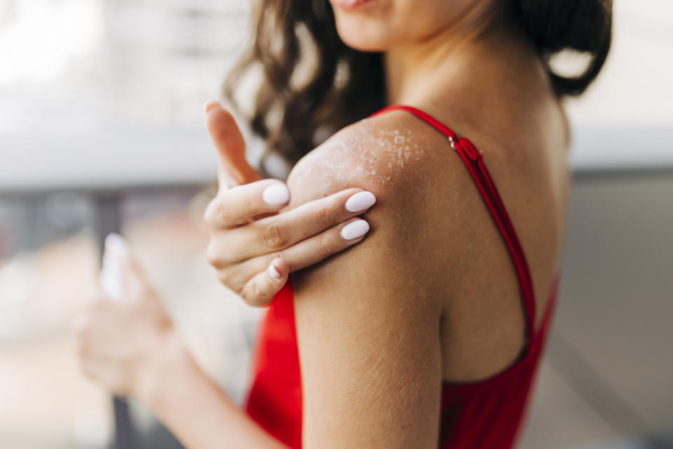 Close up of woman applying moisturiser on sunburned skin (Getty Creatives)