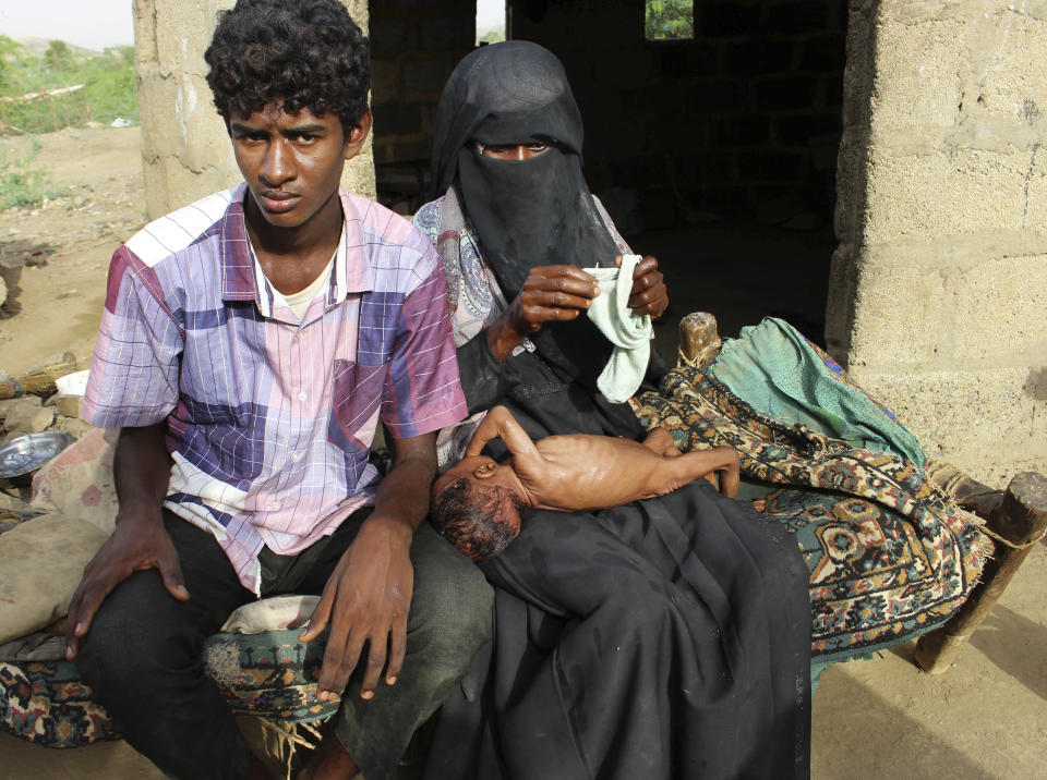 In this Aug. 25, 2018 photo, severely malnourished infant Zahra is changed by her mother, right, in the village of al-Mashradah, Aslam, Hajjah, Yemen. Yemen’s civil war has wrecked the impoverished country’s already fragile ability to feed its population. Around 2.9 million women and children are acutely malnourished; another 400,000 children are fighting for their lives only a step away from starvation. (AP Photo/Hammadi Issa)