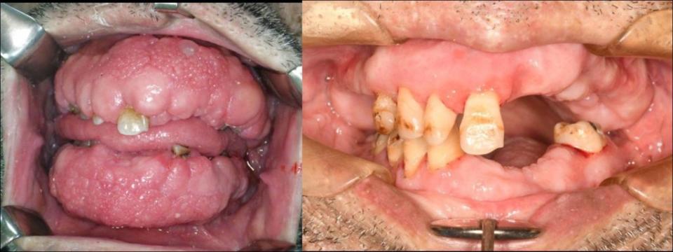 楊姓病人治療前口腔牙齦纖維瘤多到看不見牙齒（左），經過電燒合併二氧化碳雷射切除腫瘤手術後可看見牙齒露出（右）。<br />（記者王正平攝）