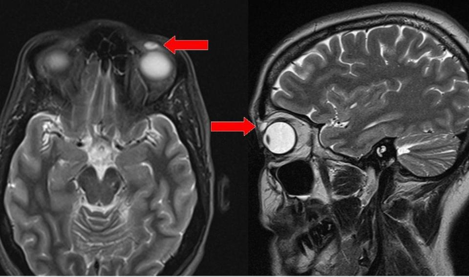 The contact was discovered after the woman complained of a “lump” on her eye. Doctors discovered a cyst, and when they tried to remove it, it ruptured and revealed the contact lens. <i>(Photo courtesy BMJ Case Reports)</i>