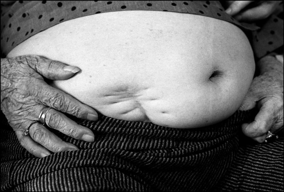 「大桃阿嬤」黃阿桃的肚子有個明顯的開刀傷疤，那是她被迫成為慰安婦時，被炸彈碎片擊中的痕跡，她為此失去子宮，也歷經自己把腸子塞回肚子裡去就醫的悲慘歷程。黃子明提供