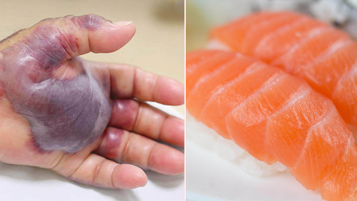 A South Korean man developed a flesh-eating bacteria after eating raw sushi. Source: New England Journal of Medicine (left)/File:Getty Images (right).