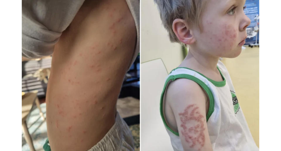 Riley Kingscote with a rash on his chest (left) and the rash from the henna tattoo (right).
