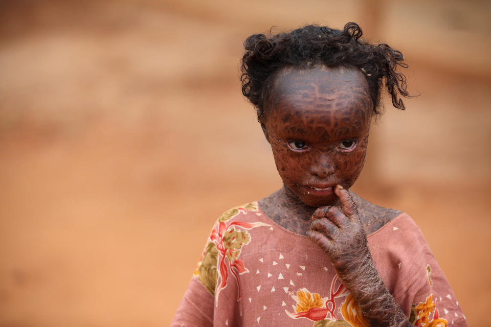 Displaced People At Dadaab Refugee Camp As Severe Drought Continues To Ravage East Africa