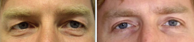 Male eyelid surgery