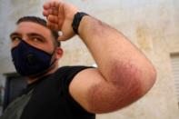 Palestinian cyclist Samer Kurdi shows his bruised arm in Ramallah in the Israeli-occupied West Bank