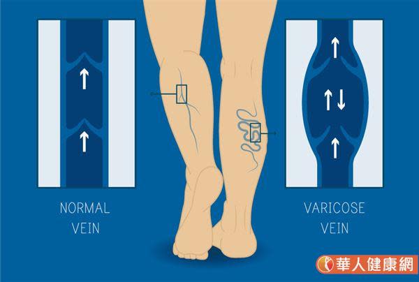 靜脈曲張是一種因雙腳靜脈瓣膜缺損，造成下肢循環不良所引起的疾病。其發生原因則大部分與患者體質遺傳，工作需經常久站，或是懷孕都有關係。