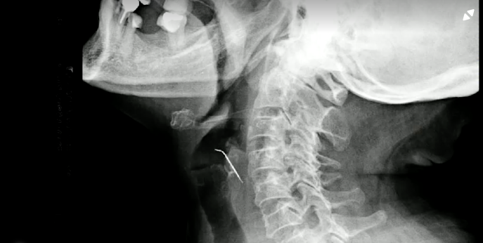 An x-ray image shows the nail accidentally swallowed by a 68-year-old woman who was eating pork rinds in February.  / Credit: EsSalud via Reuters