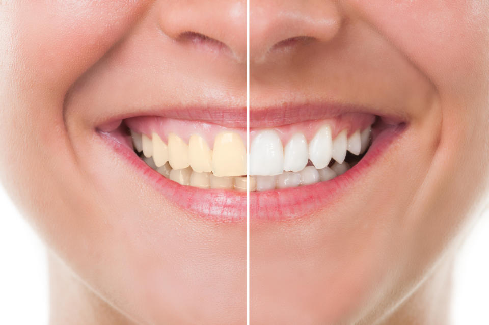 Some people brush too hard thinking it will achieve a whiter smile. (Getty Images)