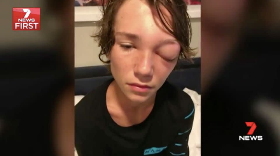 Riley after his sinus infection. Source: 7 News