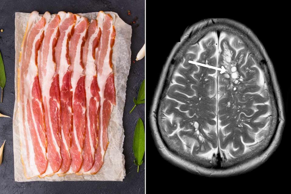 <p>Getty; American Journal of Case Reports</p> Stock image of raw bacon alongside scan of tapeworm eggs in man