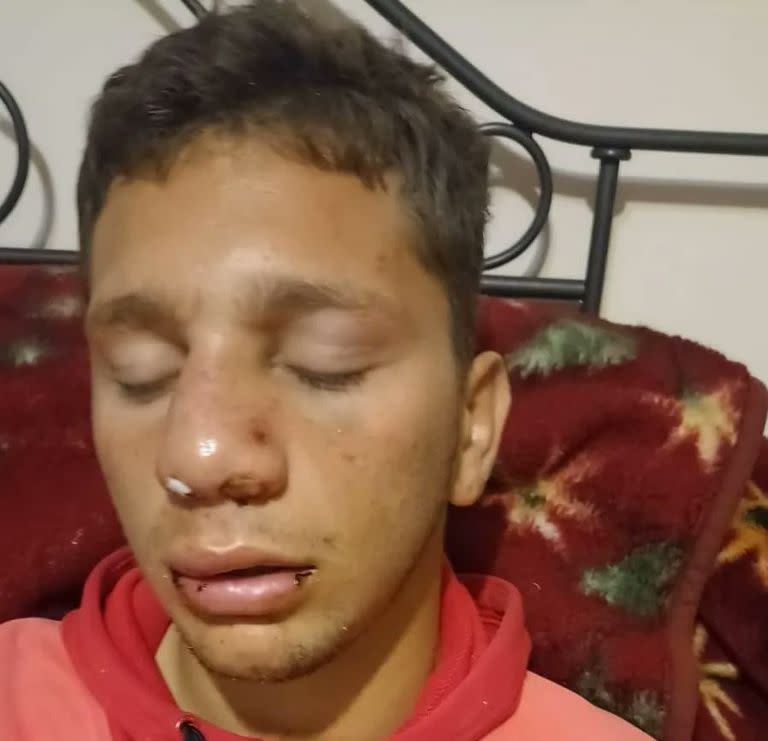 El joven padeció una fractura facial y debió ser hospitalizado