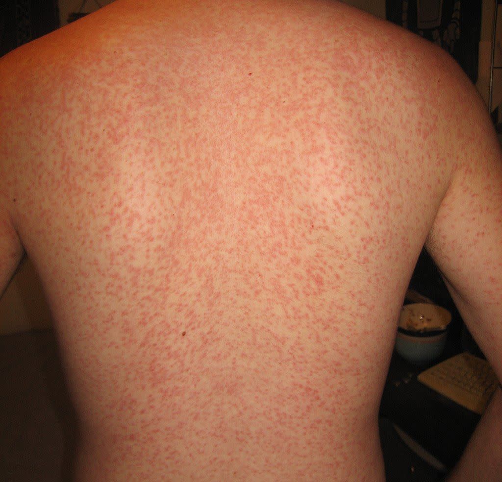 drug rash allergy