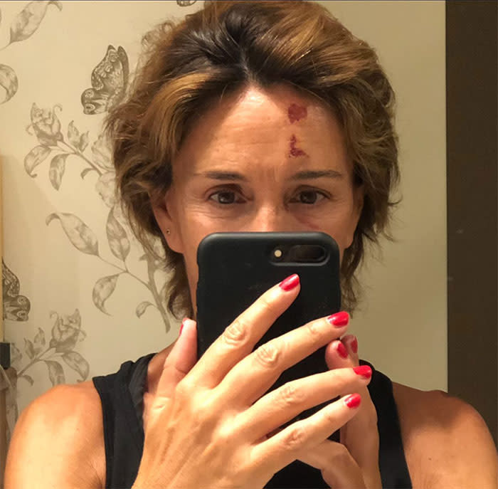 Lydia Bosch muestra las heridas de su rostro