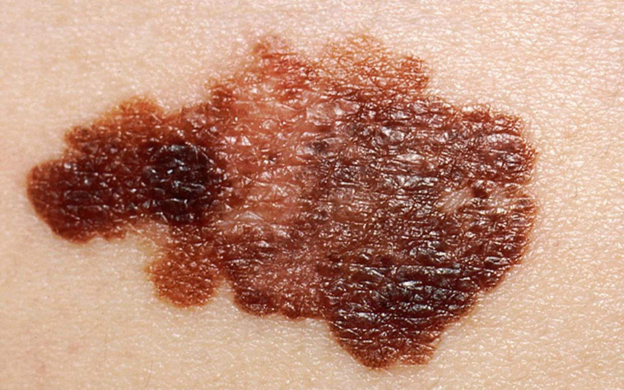 Early stage melanoma can often be difficult to distinguish from a mole - Cultura RF